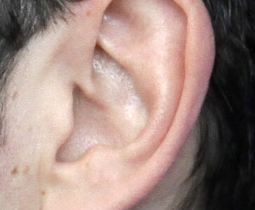 Tinnitus Hörprobleme